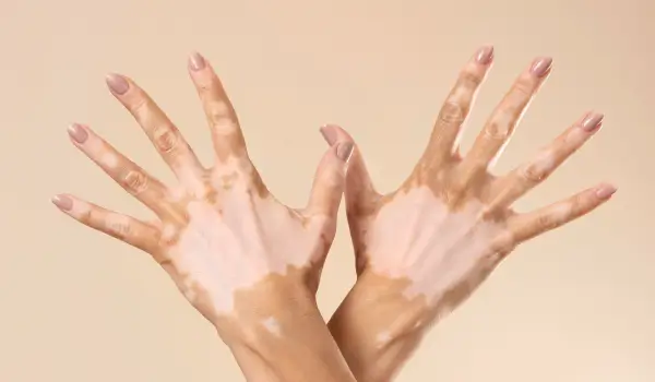 What Is Vitiligo? Understanding the Condition Michael Jackson Spoke About