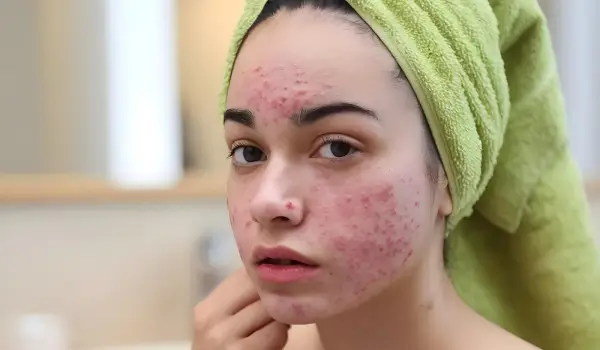 Skin Itching, Acne or Red Rashes? When It’s Time to See a Dermatologist