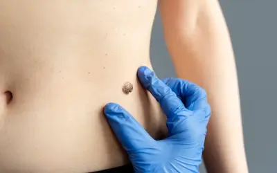 Chemical Peels vs Laser Treatment