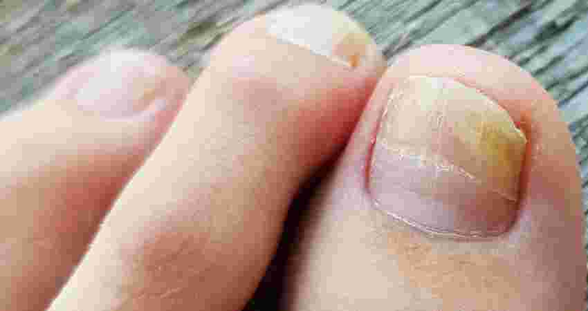 Nail Abnormalities Treatment