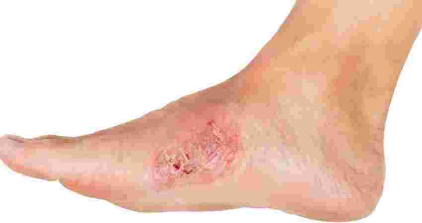 Non Healing Ulcer Treatment