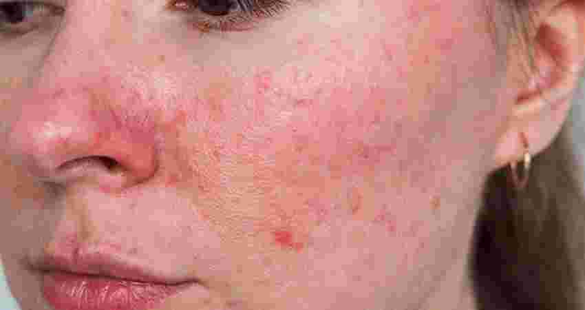 Rosacea Treatment at Root Clinic