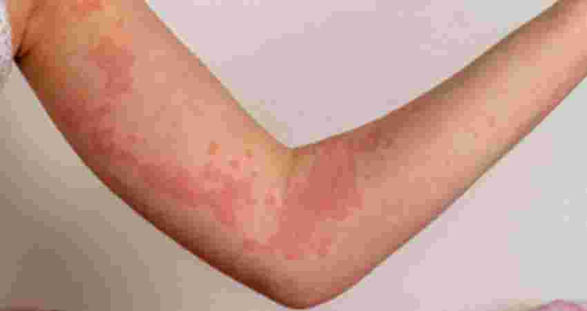 Urticaria Treatment at Root Clinic